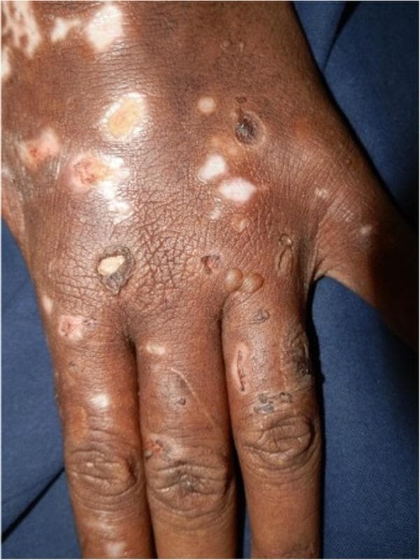 Clinical photograph showing the dorsum of a hand in a patient with darker skin (Fitzpatrick type IV-VI), demonstrating classic manifestations of Porphyria Cutanea Tarda (PCT). The image shows a polymorphic eruption characterized by multiple tense bullae (blisters), some of which have ruptured to form raw, red erosions. Chronic changes are prominent, including mottled pigmentary alterations with areas of hyperpigmentation and vitiligo-like hypopigmentation (depigmentation). Shallow, atrophic scars and evidence of skin fragility are visible across the metacarpal area and phalanges. The skin texture appears thickened with exaggerated markings (lichenification), consistent with chronic photo-induced damage. These findings illustrate the hallmark features of PCT, where porphyrin-mediated phototoxicity leads to extreme mechanical fragility and blistering in sun-exposed areas. This visual is highly relevant for medical education regarding metabolic photodermatoses and their differential diagnosis from chronic actinic dermatitis or pellagra.