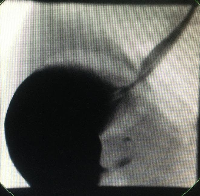 This diagnostic image is an upper gastrointestinal contrast study (fluoroscopy/X-ray) demonstrating gastric outlet obstruction. The image reveals a significantly dilated, globular stomach filled with radiopaque contrast material, appearing as a dense dark mass. There is a marked delay in gastric emptying, with only a thin, elongated stream of contrast (the 'string sign') visualized passing through a narrowed, hypertrophied pylorus into the distal duodenum. The clinical significance of these findings is highly suggestive of Infantile Hypertrophic Pyloric Stenosis (IHPS). The study serves as an educational example for pediatric gastroenterology and radiology, highlighting the visual contrast between the massive proximal gastric distension and the restricted flow into the small intestine caused by pyloric hypertrophy.