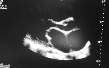 This diagnostic image is a transthoracic echocardiogram in a parasternal long-axis (PLAX) view, illustrating classic findings of rheumatic mitral stenosis. The visual focus is on the mitral valve apparatus, where the anterior mitral valve leaflet demonstrates characteristic 'doming' during diastole, often referred to as a 'hockey-stick' deformity. Both the anterior and posterior leaflets appear significantly thickened with increased echogenicity, suggesting fibrosis and possible calcification. There is evidence of subvalvular involvement, including thickening of the chordae tendineae. The left atrium appears dilated, a common secondary hemodynamic consequence of restricted mitral inflow and chronic pressure overload. In contrast, the left ventricle chamber size remains within relatively normal proportions in this view. The image serves as an educational example of valvular heart disease, specifically highlighting the morphological changes associated with chronic rheumatic carditis in a clinical cardiology setting.