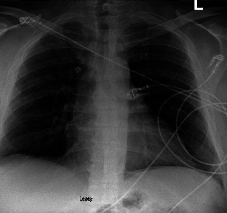This diagnostic image is a posterior-anterior (PA) view chest X-ray of an adult patient. The radiograph demonstrates normal pulmonary and pleural findings. Both lung fields are clear, with no evidence of focal airspace consolidation, interstitial infiltrates, or pulmonary masses. The costophrenic and cardiophrenic angles are sharp and well-defined, indicating the absence of pleural effusion. No pneumothorax is visible. The cardiomediastinal silhouette is within normal limits for size and contour, and the trachea is midline. External artifacts, specifically several electrocardiogram (ECG) leads and wires, are superimposed over the thoracic cavity and upper abdominal region. The osseous structures of the rib cage, clavicles, and proximal humeri appear intact. This image serves as an educational example of a normal chest radiograph used in clinical triage to rule out acute cardiopulmonary pathology in patients presenting with symptoms such as chest pain or hypertension.