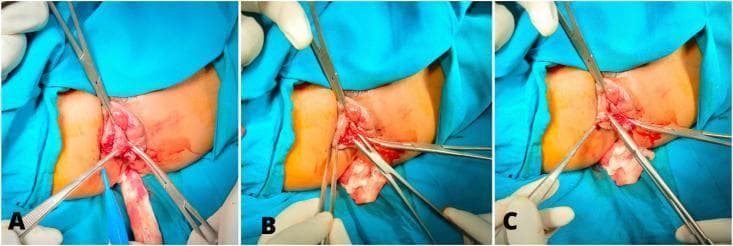 This clinical photograph set illustrates three sequential stages of a surgical hemorrhoidectomy. Image A shows the initial surgical phase where a triangle incision is being made above the dentate line on the protruding hemorrhoidal tissue, with surgical clamps and forceps used to provide traction and exposure. Image B depicts the intraoperative stage of hemorrhoidal excision, showing the removal of the piles while maintaining hemostasis with surgical instruments. Image C demonstrates the final stage of wound closure, where simple interrupted sutures are placed radially to close the excision site. The radial orientation of the sutures is designed to prevent mucosal prolapse and minimize the risk of anal stenosis. The images provide a detailed view of the surgical field, including the use of multifilament absorbable sutures and surgical drapes, highlighting a specific technique for treating circular hemorrhoids at the 3, 7, and 11 o'clock positions.