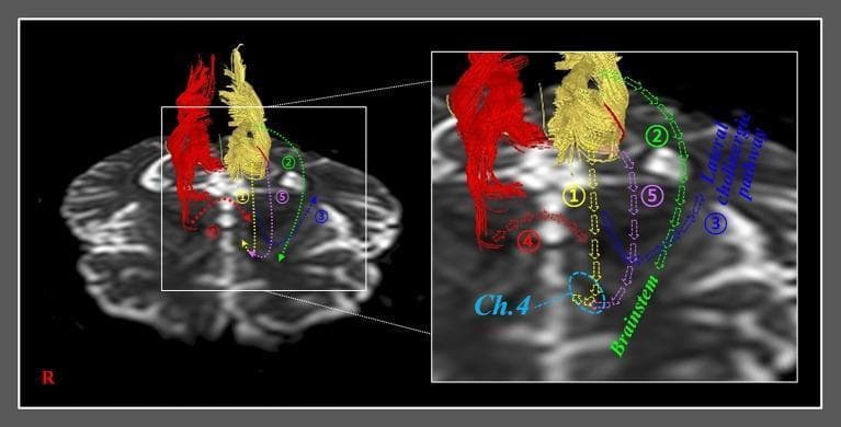 This diagnostic image is a diffusion tensor tractography (DTT) reconstruction overlaid on a grayscale MRI axial slice of the human brain, illustrating five proposed recovery mechanisms for the injured anterior cingulum. The visualization uses colored dotted arrows to represent neural tract trajectories. Mechanism 1 (yellow) shows the normal pathway of the cingulum descending to the basal nucleus of Meynert (Ch. 4). Mechanism 2 (green) depicts a curved pathway descending toward the brainstem cholinergic nuclei. Mechanism 3 (blue) represents the lateral cholinergic pathway extending toward the temporo-occipital white matter. Mechanism 4 (red) demonstrates an interhemispheric tract connecting the contralesional and ipsilesional basal forebrains via the genu of the corpus callosum. Mechanism 5 (purple) illustrates an aberrant pathway from the injured cingulum also terminating at Ch. 4. The diagram serves as an educational model for neuroplasticity and cholinergic system compensation following brain injuries such as traumatic brain injury (TBI) or stroke, highlighting specific neuroanatomical landmarks including the brainstem, basal forebrain, and cingulate cortex.