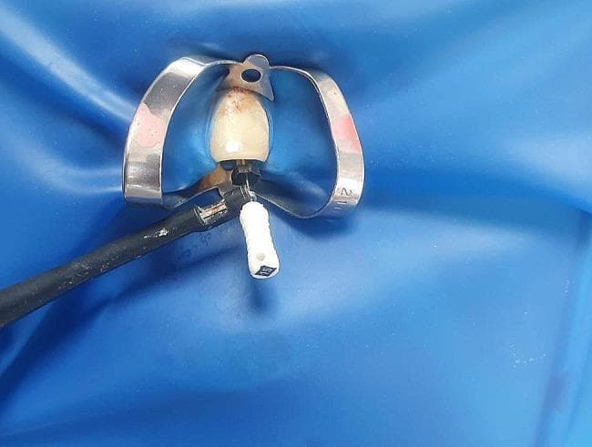 A clinical procedural photograph showing an endodontic setup for electronic apex localization. A single anterior tooth is isolated using a blue rubber dam and a stainless steel cervical clamp. The tooth crown is off-white with visible reddish-brown staining near the gingival margin. A K-file with a white handle (size 15) is inserted into the root canal access cavity. An electronic apex locator (EAL) electrode probe, featuring a black insulated wire and metal contact, is attached to the metal shaft of the K-file. This configuration is used to determine the working length of the root canal by measuring electrical impedance. The setup demonstrates standard isolation protocols to maintain a dry field and prevent contamination during endodontic therapy.