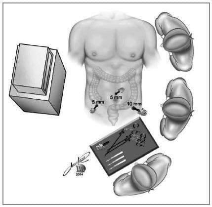 This medical illustration depicts the surgical setup and port placement for a laparoscopic appendectomy. The central focus is a torso diagram showing three trocar sites in the lower abdomen: a 5mm trocar in the right iliac fossa, a 5mm umbilical/suprapubic port, and a larger 10mm trocar in the left iliac fossa. The underlying anatomy highlights the large intestine, particularly the cecum and appendix region, to demonstrate the surgical approach. The surrounding elements provide a birds-eye view of the operating room configuration, featuring the laparoscopic monitor to the patient's right, the surgeon and assistant positioned on the patient's left, and a scrub nurse at the foot of the table. A sterile instrument tray is shown containing laparoscopic graspers, a monopolar hook, and additional trocars. This diagram serves as a clinical guideline for ergonomic positioning and port triangulation during minimally invasive abdominal surgery.