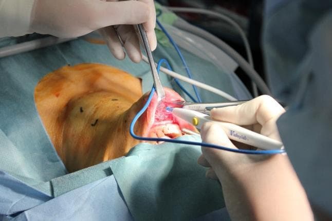 This clinical photograph captures a Transoral Video-Assisted Neck Surgery (TOVANS) for thyroidectomy. The patient is in a supine position with the neck extended to provide optimal access. The surgical field is established with sterile blue drapes, and the primary incision is located at the oral vestibule between the inferior lip and the gingiva, exposing the underlying vascular tissue and teeth. Two surgeons are actively engaged in the procedure; one uses a metal retractor to maintain the vestibular opening, while the other utilizes a white-handled Valleylab electrocautery device for tissue dissection. Surgical markings (black lines) are visible on the skin of the anterior neck to guide the subplatysmal tunneling. This approach is designed to provide a scarless outcome on the neck by accessing the thyroid gland through the oral cavity. Blue suction or irrigation tubing is present within the operative field, which is a key component of the sterile, controlled environment required for head and neck endocrine surgery.