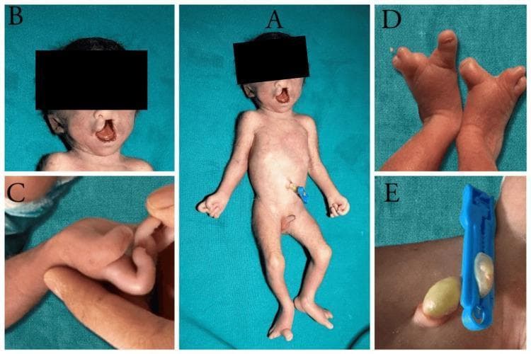 A multi-panel clinical photograph of a neonate illustrating various congenital anomalies associated with Fetal Hydantoin Syndrome. Panel A provides a full-body view showing a two-vessel umbilical cord (single umbilical artery) and dysmorphic features. Panel B (facial close-up) highlights a complete midline cleft lip and palate, a broad nasal bridge, and low-set ears; the ocular region is obscured for privacy but clinical context indicates hypertelorism. Panel C demonstrates hand abnormalities, including hypoplastic distal phalanges and digital contractures. Panel D focuses on the lower extremities, showing oligosyndactyly (reduction in digit number with fusion) and absent distal phalanges in bilateral feet. Panel E provides a close-up of the umbilical cord insertion with a medical clamp, confirming the presence of a single umbilical artery. These visual findings serve as clinical markers for teratogenic exposure to phenytoin, emphasizing phenotypic variations in craniofacial and limb development. The presentation is intended for medical education regarding dysmorphology and embryological disorders.