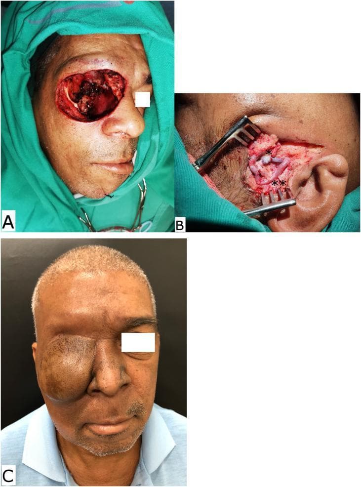 A sequence of clinical photographs illustrating the surgical reconstruction of a midface defect following tumor resection. (A) Intraoperative view of a right orbital exenteration and midface defect after surgical excision of advanced cutaneous squamous cell carcinoma, showing exposed orbital cavity and surrounding facial soft tissue. (B) High-magnification intraoperative view of the microsurgical field in the preauricular region. It demonstrates the microanastomosis of the superficial temporal recipient vessels: a single asterisk (*) marks the venous anastomosis between the superficial temporal vein and the flap vein, while a double asterisk (**) indicates the arterial anastomosis between the superficial temporal artery and the flap artery. (C) Late postoperative photograph of the patient following reconstruction with an anterolateral thigh (ALT) free flap. The flap provides voluminous coverage of the orbital and midface defect, demonstrating successful tissue transfer and wound closure. This series is an educational resource for plastic and reconstructive surgery, highlighting head and neck oncology, microvascular free flap reconstruction, and management of advanced skin malignancies.
