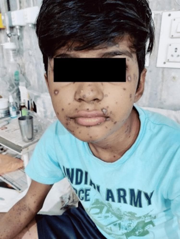 This clinical photograph shows a pediatric patient with a widespread, pleomorphic rash consistent with Varicella-Zoster Virus infection. The lesions are distributed across the face, neck, and upper extremities. The image illustrates the characteristic 'dewdrop on a rose petal' appearance in various stages of evolution, including erythematous macules, papules, clear vesicles, and some lesions that have begun to umbilicate or form crusts. On the face and perioral region, several lesions have become confluent, forming larger, crusting patches. The distribution is centripetal and diffuse, highlighting the hallmark clinical presentation of chickenpox where lesions in multiple different stages of development (macules to crusts) coexist simultaneously. This visual is an essential educational example for dermatology and infectious diseases, demonstrating typical primary varicella in an immunocompromised or high-risk clinical context.
