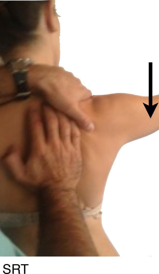This clinical photograph demonstrates the Scapular Retraction Test (SRT), a physical examination maneuver used in sports medicine and orthopedics to assess scapular dyskinesis and its contribution to shoulder impingement or rotator cuff symptoms. The image shows a posterior view of a patient with their right arm in slight abduction. An examiner stands behind the patient, performing manual stabilization: one hand is placed broadly over the medial border and body of the scapula to facilitate retraction and posterior tilting, while the other hand provides stabilization at the superior aspect of the shoulder near the acromion. A black directional arrow indicates the application of a resisted downward force on the distal humerus. The educational purpose of this visual is to illustrate the correct hand placement for manual scapular assistance during strength testing, helping clinicians determine if mechanical stabilization of the scapula reduces pain or increases the strength of the supraspinatus muscle.