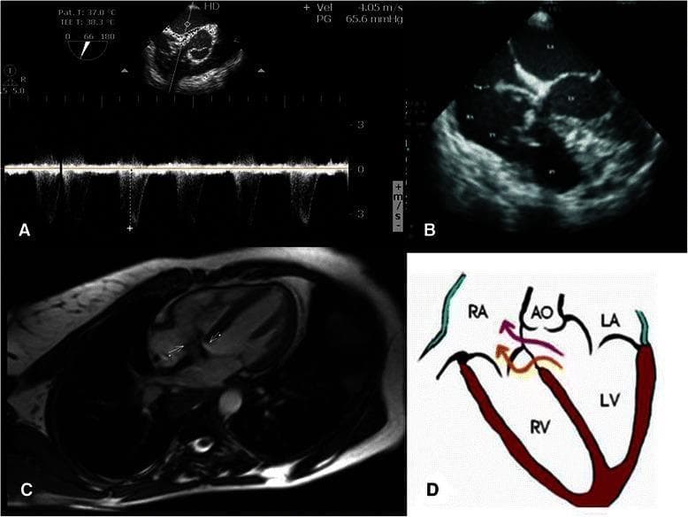 This composite figure illustrates the multi-modal diagnostic assessment of a C-type acquired Gerbode defect. Panel A displays a Transesophageal Echocardiography (TEE) with spectral Doppler, showing a high-velocity systolic shunt (4.05 m/s) with a pressure gradient of 65.6 mmHg, indicating a left-to-right shunt. Panel B is a Transthoracic Echocardiogram (TTE) in a four-chamber view, identifying an irregularly shaped, oscillating, and mobile echogenic mass (vegetation) attached above the septal leaflet of the tricuspid valve. Panel C presents a Cardiac Magnetic Resonance (CMR) image in a horizontal long-axis view, where white arrows highlight the pathological communication between the left ventricle (LV), right atrium (RA), and right ventricle (RV). Panel D provides a corresponding anatomical diagram mapping the shunt flow; it shows a complex C-type Gerbode defect consisting of both supravalvular (LV to RA) and infravalvular (LV to RV) components. This collection demonstrates how structural imaging and hemodynamics confirm the presence of infective endocarditis complicated by an acquired intracardiac shunt.