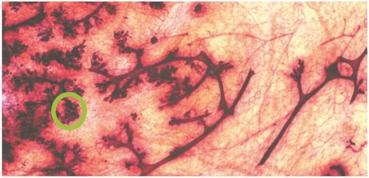 This whole mount preparation showcases the anatomical architecture of the adolescent human breast from a 15-year-old female. The image highlights a branching ductal network embedded within a matrix of translucent adipose tissue. The mammary ducts appear as dark, linear structures that radiate and subdivide throughout the tissue. Along the lateral edges and at the distal ends of these ducts are lobular structures characterized by increased staining density and granular morphology. A green circle highlights a Terminal Duct Lobular Unit (TDLU), which represents the primary functional unit of the breast where secretory activity occurs. The TDLU is visible as a compact, rounded cluster of buds emerging from a terminal duct. This histological overview illustrates the pubertal development of the mammary gland, specifically the expansion of the epithelial ductal system and the formation of complex terminal units in response to hormonal signaling. The clear visualization of the branching patterns and the high-contrast staining of the epithelial elements against the pale surrounding stroma provide an educational example of normal breast microanatomy during early reproductive development.