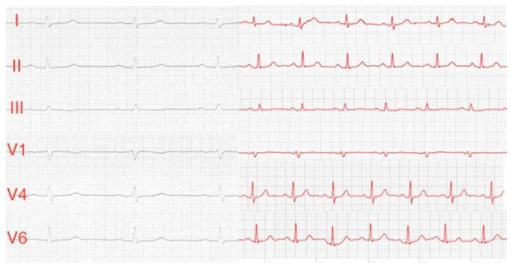 This diagnostic image is a comparison chart of electrocardiography (ECG) tracings, displaying a side-by-side assessment of six leads (I, II, III, V1, V4, and V6). The left column shows standard 12-lead ECG recordings in black, while the right column shows corresponding single-lead ECGs captured by a smartwatch (Apple Watch) in red. The image demonstrates high morphological correlation between the two modalities across Einthoven limb leads (I-III) and Wilson-like chest leads (V1, V4, V6). Key visual features include visible P waves, sharp QRS complexes, and T waves in both sets. Notably, the smartwatch recordings (red) exhibit higher relative amplitudes and slightly more baseline wander compared to the standard ECG (black). In lead V1, both modalities show a predominant S-wave, reflecting correct precordial placement. This educational material serves to illustrate the clinical utility and signal quality of consumer-grade wearables in mimicking standard diagnostic leads for heart rhythm and waveform analysis.