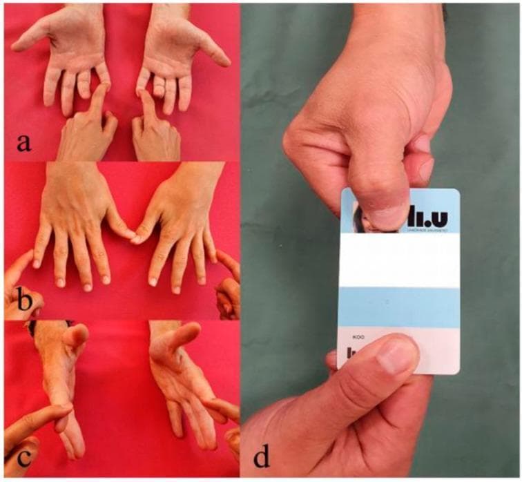 This composite of clinical photographs illustrates the physical examination maneuvers for assessing ulnar nerve motor function. (a) Displays the clinical test for the flexor digitorum profundus (FDP) of the little finger, with the examiner stabilizing the finger to isolate distal interphalangeal joint flexion. (b) Shows the assessment of the abductor digiti minimi (ADM) muscle through resisted abduction of the little finger. (c) Demonstrates the evaluation of the first dorsal interosseous (FDI) muscle, involving resisted abduction of the index finger. (d) Highlights a positive Froment's sign, a classic indicator of ulnar nerve palsy. The patient attempts to hold a card between the thumb and index finger; due to weakness of the ulnar-innervated adductor pollicis, the patient exhibits compensatory hyperflexion at the thumb's interphalangeal joint, powered by the median-innervated flexor pollicis longus. These tests collectively evaluate the integrity of the ulnar nerve and its intrinsic and extrinsic hand muscle innervation.