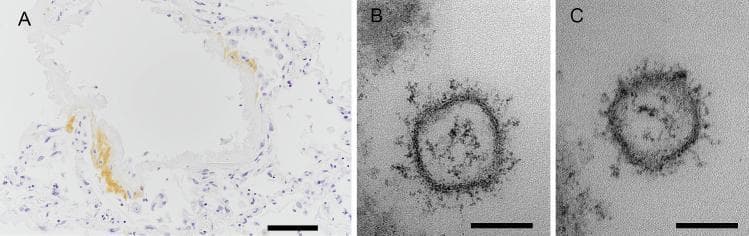 This composite figure demonstrates diagnostic evidence of SARS-CoV-2 infection within lung tissue using immunohistochemistry (IHC) and electron microscopy (EM). Image A (scale bar 100 μm) is an IHC-stained light microscopy section of the right lung. It reveals human lung architecture with clear alveolar spaces; positive brown chromogen immunoreactivity is localized to the hyaline membranes lining the alveolar walls, indicating the presence of SARS-CoV-2 nucleocapsid protein. This finding is characteristic of the exudative phase of diffuse alveolar damage (DAD) in COVID-19. Images B and C (scale bar 100 nm) are high-magnification transmission electron micrographs showing individual viral particles in the extracellular space. The virions are roughly spherical, measuring approximately 100 nm in diameter. Key ultrastructural features include a distinct outer lipid envelope and prominent surface projections (spike proteins), creating a classic 'corona' appearance. The internal electron-dense material represents the viral ribonucleoprotein complex. Together, these images illustrate the correlation between histopathological antigen localization and direct ultrastructural visualization of virions in severe respiratory viral infection.