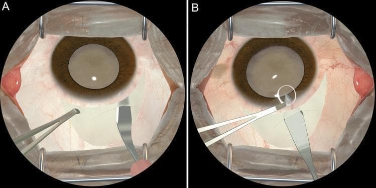 This surgical diagram displays a surgeon's-eye view of a simulated Manual Small Incision Cataract Surgery (MSICS), specifically focusing on the creation of a scleral tunnel. The visual consists of two panels, A and B, rendered via a virtual reality simulator. In both frames, the eye is held open by a wire lid speculum, revealing the conjunctiva, vascularized sclera, a brown iris, and a centrally located lens. Panel A illustrates the tunnel dissection phase, where a crescent knife is utilized to create a lamellar pocket within the sclera. Panel B demonstrates the subsequent step of entering the anterior chamber; a keratome is shown penetrating the previously dissected tunnel into the eye, with a white circle highlighting the point of entry. The primary educational focus is the visualization of precise instrument angles and anatomical positioning required for successful scleral tunnel construction during cataract procedures.