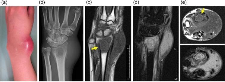 This composite figure demonstrates the multimodality diagnostic workup of a lesion in the distal radius, likely representing subacute osteomyelitis. (a) Clinical photograph of the wrist shows localized erythema and a prominent, firm swelling on the dorsal-radial aspect. (b) Anteroposterior plain radiograph reveals an ill-defined osteolytic lesion in the distal radial metaphysis accompanied by adjacent soft tissue swelling. (c-e) MRI series provides detailed characterization: (c) Coronal T1-weighted image shows a low-signal intensity marrow lesion with a characteristic hyperintense 'penumbra sign' (yellow arrow) at the periphery, a feature highly suggestive of Brodie's abscess. (d) Coronal T2-weighted fat-suppressed image shows high-signal intensity (edema) within the lesion and extensive reactive marrow and soft tissue edema. (e) Axial T1 and T2 fat-suppressed images illustrate the intraosseous lesion and associated extraosseous fluid collection (abscess). This sequence illustrates key radiological markers for bone infection, contrasting bony destruction on X-ray with inflammatory signal changes and specific diagnostic signs on MRI.