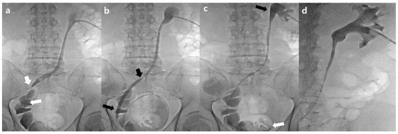 This composite of four fluoroscopic images (a-d) demonstrates the antegrade management of a uretero-ileal anastomosis stricture (UIAS) in a patient with a prior radical cystectomy and orthotopic neobladder. Image (a) is an antegrade nephrogram via an existing percutaneous nephrostomy (PCN) tube, showing a contrast-filled ureter with a severe segmental stenosis (approx. 2.4 cm) at the distal ureter/anastomosis site. Image (b) illustrates interventional balloon dilatation, featuring an inflated 6 mm balloon catheter at the point of stricture to restore patency. Image (c) shows the successful placement of a 6F double-J ureteral stent; the proximal pigtail is positioned in the renal pelvis (black arrow), and the distal pigtail is within the neobladder (white arrow). Image (d) is a post-procedural nephrogram confirming contrast flow and absence of significant blood clots (grade 1 retention). The series provides a visual guide for urological interventional procedures including nephrostomy access, balloon angioplasty of the urinary tract, and ureteral stenting for diversion-related complications.