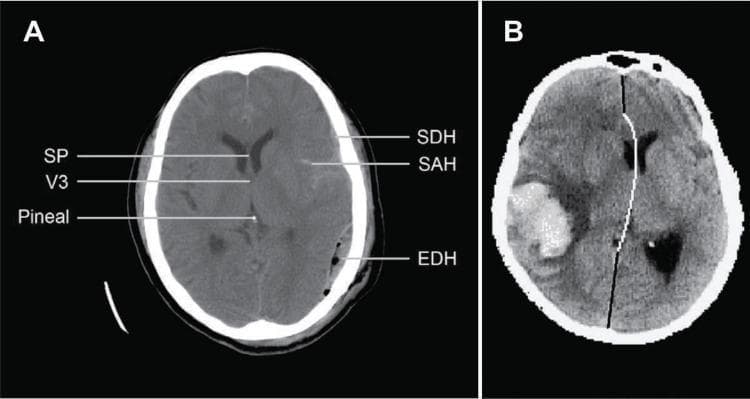 This educational composite contains two axial non-contrast computed tomography (CT) scans of the brain demonstrating various intracranial hemorrhages and mass effect. Image A illustrates traumatic brain injury findings with multiple hemorrhage types: a crescentic subdural hematoma (SDH), subarachnoid hemorrhage (SAH) within the sulci, and a biconvex/lens-shaped epidural hematoma (EDH) on the patient's right side. Key anatomical landmarks annotated include the septum pellucidum (SP), third ventricle (V3), and the pineal gland. Image B depicts a large, hyperdense, oval-shaped intracerebral hematoma (ICH) in the right hemisphere. This lesion exerts significant mass effect, resulting in a prominent midline shift (MLS), visualized by a curved white line showing the deviation of the brain's midline structures toward the left. The content is designed for neurosurgical and radiological education, focusing on identifying different hemorrhage patterns and quantifying midline shift in acute clinical settings.