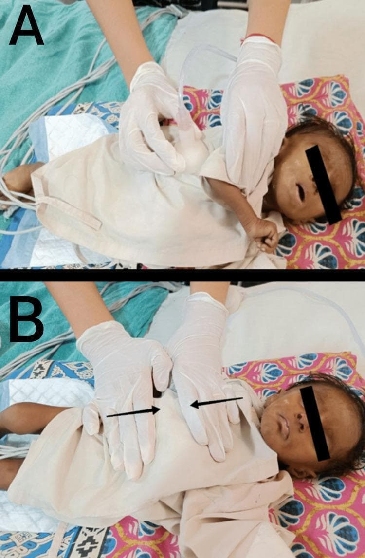 This clinical photograph consists of two panels (A and B) demonstrating postoperative pediatric chest physiotherapy techniques on a three-month-old infant in a supine position. Panel A illustrates mechanical chest vibration, where a healthcare worker in sterile gloves uses a handheld percussor cup with an attached suction/vibration tube against the infant's thoracic wall to facilitate airway clearance. Panel B depicts a manual respiratory therapy technique known as prolonged slow expiration (PSE). In this panel, the practitioner's gloved hands are positioned on the infant's thorax and abdomen, with superimposed black arrows indicating the direction of manual pressure applied to assist with expiratory flow and secretion mobilization. The infant is monitored via chest leads visible in the background and is supported on patterned bedding. These procedures are typical in neonatal or pediatric postoperative care following cardiothoracic surgery to prevent atelectasis and manage pulmonary secretions.
