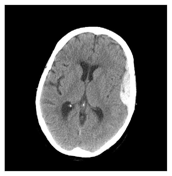This diagnostic image is an axial non-contrast Computed Tomography (CT) scan of the head, demonstrating traumatic intracranial hemorrhage. The image reveals two distinct extra-axial collections in the left hemisphere. A hyperdense, biconvex (lens-shaped) epidural hematoma is localized in the left temporal region, exerting mass effect on the adjacent brain parenchyma. Anterior to this, a thin, hyperdense, crescent-shaped subdural hematoma is visible along the left frontal convexity, conforming to the cortical surface. The underlying cerebral tissue shows subtle signs of edema, indicated by a faint blurring of the grey-white matter interface in the left hemisphere. The lateral ventricles are visible and appear symmetric without significant compression, and there is no evident midline shift in this section. The calvarium appears intact without gross fractures. This scan serves as a clinical example of co-occurring epidural and subdural hematomas, highlighting the classic morphological differences between these two types of traumatic brain injuries.