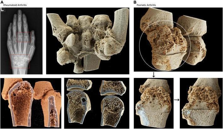 This composite educational image provides a comparative visual analysis of bone pathology in Rheumatoid Arthritis (RA) and Psoriatic Arthritis (PsA) using conventional radiography and high-resolution CT-based cinematic rendering. Panel A focuses on RA, showing a standard hand X-ray with highlighted carpal and metacarpophalangeal joint involvement, paired with 3D renderings that demonstrate significant marginal erosions, carpal bone deformities, and trabecular demineralization characteristic of chronic inflammation and joint destruction. Panel B illustrates PsA, utilizing photorealistic cinematic renderings to showcase the distinct dual processes of bone erosion and pathological new bone formation (proliferation). The high-resolution cross-sectional views reveal the 'inner life' of the bone, highlighting pitted surfaces and cortical irregularities. This visual comparison serves as a diagnostic educational tool for identifying the predominately destructive nature of RA versus the mixed erosive-proliferative features of PsA in the small joints of the hand. It is intended for rheumatology and radiology education to enhance the understanding of structural remodeling in inflammatory arthritides.