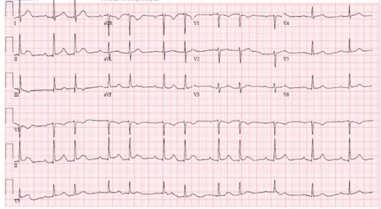 This diagnostic image is a standard 12-lead electrocardiogram (ECG) displayed on a traditional grid background, illustrating a second-degree atrioventricular (AV) block, specifically Mobitz Type I (Wenckebach phenomenon). The tracing shows characteristic patterns across the limb leads (I, II, III, aVR, aVL, aVF) and precordial leads (V1-V6). Key diagnostic features include a progressive lengthening of the PR interval in successive beats until a P wave fails to conduct to the ventricles, resulting in a dropped QRS complex. This cycle then repeats, starting with a shorter PR interval. The QRS complexes are relatively narrow, suggesting the block occurs at the level of the AV node. P-wave morphology is consistent with sinus rhythm, being upright in leads II and V2-V6 and inverted in aVR. This ECG is a critical educational tool for demonstrating non-invasive identification of conduction system pathologies and differentiating between types of second-degree heart blocks.