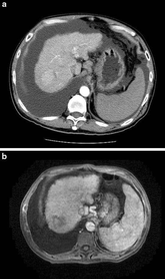 This comparative medical visual consists of two axial cross-sectional diagnostic images illustrating a case of hepatocellular carcinoma (HCC) before and after High-Intensity Focused Ultrasound (HIFU) ablation. Image (a) is a Contrast-Enhanced Computed Tomography (CECT) scan of the abdomen. It reveals a nodular, cirrhotic liver with a hypervascular hepatocellular carcinoma located at the liver dome. Significant gross ascites is visible as hypodense fluid accumulation surrounding the liver, spleen, and stomach, consistent with advanced (Child-Pugh C) cirrhosis. Image (b) is a Magnetic Resonance Imaging (MRI) scan of the same patient taken one month following HIFU ablation. The comparison demonstrates successful treatment, where the previously visible tumor in the liver dome shows signs of complete ablation with no evidence of residual enhancing tumor. The presence of significant ascites remains visible. These images are used in hepatology and oncology to demonstrate the feasibility and efficacy of non-invasive ablation techniques in patients with compromised liver function and perihepatic fluid.