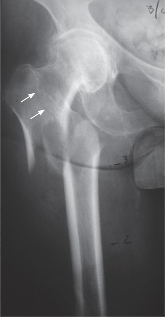 This diagnostic image is an anterior-posterior (AP) X-ray radiograph of the proximal right femur and partial pelvis. The anatomical landmarks depicted include the femoral head, femoral neck, greater and lesser trochanters, and the proximal femoral shaft. The image demonstrates a fracture involving the proximal femur with a visible fracture line extending superiorly into the greater trochanteric region, indicated by two white arrows. The cortical bone appears thinned, and there is a noticeable disruption of the normal trabecular pattern in the femoral neck, characteristic of a fragility-type fracture. The orientation of the fracture line through the greater trochanter is used to differentiate typical fragility fractures from atypical femoral fractures. External artifacts, including numeric markers and wire-like lines, are visible across the femoral shaft, likely used for intraoperative or radiographic measurement. The image serves as an educational tool for orthopedic classification, illustrating the distinction between fragility fractures and atypical femoral stress fractures based on anatomical involvement.