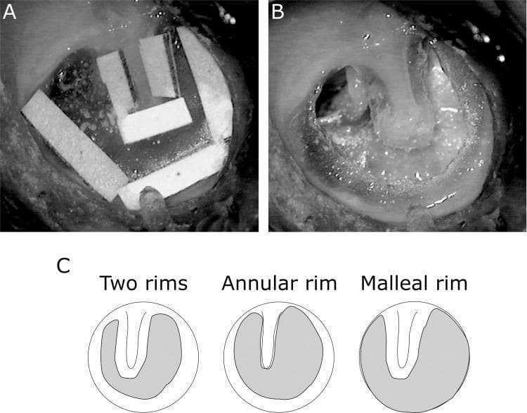 This composite educational image illustrates experimental tympanic membrane (TM) perforation models used in otolaryngology research. Panel A is a clinical endoscopic photograph showing a temporal bone preparation with 1mm rectangular white paper patches applied to the surface of the TM. These patches serve as protective markers to delineate and preserve specific TM remnants, including the annular rim and the malleal rim adjacent to the umbo. Panel B displays the resulting large subtotal central perforation after surgical excision. It demonstrates a 'two rims' condition, where two distinct segments of native TM tissue remain: a peripheral rim along the annulus and a central rim attached to the malleus and umbo. Panel C is a schematic diagram illustrating three experimental rim conditions: 'Two rims' (preserving both annular and malleal tissue), 'Annular rim' (preserving only the periphery), and 'Malleal rim' (preserving only the central attachment). Shaded grey areas indicate the regions of membrane removal. This visual material is used to study middle ear mechanics, sound conduction, and the efficacy of different grafting materials in myringoplasty.