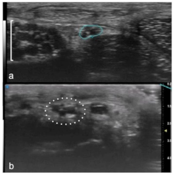 Ultra-High Frequency Ultrasound (UHFUS) images demonstrating the detailed anatomy of small peripheral branches of the median nerve in the hand. Panel (a) shows a cross-sectional view at the level of the thenar eminence; the recurrent branch of the median nerve is identified as a hypoechoic, rounded structure (indicated by the line marking) within the surrounding soft tissue (marked with a square parenthesis). Panel (b) provides an ultra-high resolution view of a digital branch of the median nerve at the finger level. Enclosed within a dotted circle, the nerve exhibits a typical 'honeycomb' internal echo-structure, characterized by multiple small hypoechoic fascicles separated by thinner hyperechoic lines. The images illustrate the clinical utility of high-frequency transducers for visualizing superficial nerve morphology, which is essential for diagnosing entrapment neuropathies, traumatic injuries, or pre-operative planning in hand surgery.