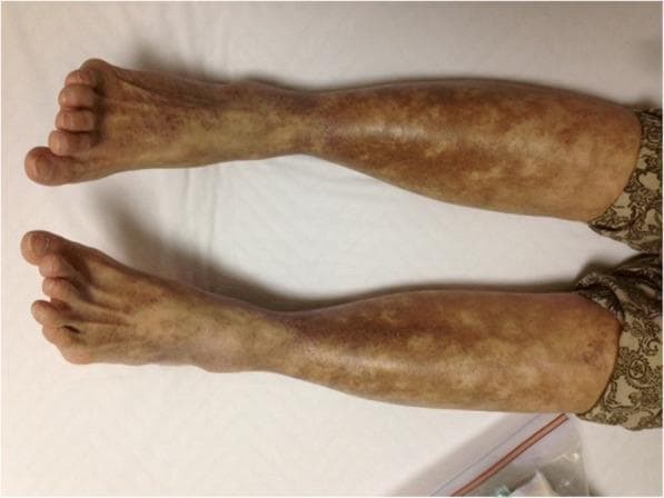 This clinical photograph displays a bilateral and symmetrical dermatological condition on the lower extremities, extending from the feet and ankles up to the proximal lower legs. The primary finding is livedo reticularis, characterized by a cyanotic, reddish-brown, reticular (net-like) pattern of skin discoloration. This mottled appearance consists of irregular rings of dusky erythema surrounding central areas of relatively pale or normal-appearing skin. The distribution is most concentrated and confluent around the distal ankles and dorsal surfaces of the feet, becoming more diffuse as it progresses toward the knees. This vascular pattern is a classic sign of impaired cutaneous blood flow, often associated with systemic conditions such as vasculitis or, as in this clinical context, type II cryoglobulinemia. There are no visible ulcerations or focal gangrene in the provided view, though the diffuse nature of the livedo suggests significant underlying small-vessel pathology.