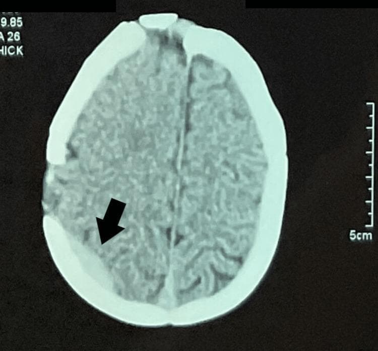 An axial non-contrast Computed Tomography (CT) scan of the head at the level of the upper cerebral convexities. The primary finding is a right-sided parietal extradural (epidural) hematoma, indicated by a black arrow. The hematoma appears as a focal, hyperdense, biconvex/lenticular-shaped collection adjacent to the inner table of the skull. A focal disruption or surgical alteration of the skull (bone flap/cranioplasty) is visible near the site of the hematoma. The surrounding brain parenchyma shows preserved gray-white matter differentiation, and there is no significant evidence of midline shift or obstructive hydrocephalus at this level. The falx cerebri remains in a midline position. This diagnostic image illustrates a postoperative complication following cranial surgery, specifically an acute extradural hemorrhage. The content is suitable for neurological, radiological, and surgical education regarding intracranial hemorrhages and postoperative monitoring.