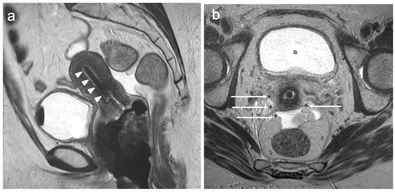 This diagnostic imaging composite displays T2-weighted magnetic resonance images (T2WI) of the female pelvis, illustrating the placement of brachytherapy equipment for the treatment of cervical cancer. Image (a) is a sagittal T2WI showing a dark, linear intracavitary brachytherapy applicator correctly positioned within the endometrial cavity, extending from the uterine fundus toward the cervix (marked by white arrowheads). Image (b) is an axial T2WI at the level of the cervix, demonstrating multiple hypointense, punctate signals representing parametrial interstitial needles (marked by white arrows). These needles are distributed within the parametrial tissues lateral to the cervix to deliver targeted radiation. The images highlight the use of MRI for real-time or post-procedural verification of applicator and needle positioning to ensure optimal dose distribution while sparing adjacent organs at risk, such as the bladder and rectum. This clinical material is intended for advanced medical education in gynecologic oncology and radiation oncology, focusing on locally advanced cervical cancer management.