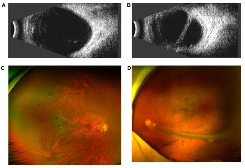 A multi-panel clinical ophthalmic display showing bilateral ocular findings in a patient with suspected Familial Exudative Vitreoretinopathy (FEVR). Panels A and B contain B-scan ultrasonography. Panel A (right eye) reveals diffuse vitreous opacities, while Panel B (left eye) demonstrates a prominent, linear hyper-echogenic band representing a retinal fold or tractional retinal detachment. Panels C and D provide wide-field scanning laser ophthalmoscopy (SLO) fundus images. Panel C (right eye) shows increased retinal vessel branching, straightening of vessels in the posterior pole, and areas of focal nasal pigmentation. Panel D (left eye) depicts a significantly more advanced pathology with a distinct, light-colored elevated retinal fold extending through the vitreous cavity, accompanied by overall hazy visualization consistent with secondary glaucoma and vitreous changes. These diagnostic images are essential for characterizing hereditary vitreoretinal dystrophies and associated structural complications like retinal folds and exudation.