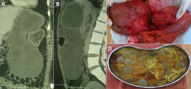 A four-panel composite image illustrating a large hepatic hydatid cyst through radiological and surgical views. Panels A and B are coronal and sagittal CT scans showing a massive, multilocular cystic lesion originating from the left hepatic lobe. The scans demonstrate significant mass effect, displacing the stomach anteriorly, the pancreas posteriorly, and the transverse colon inferiorly. Panel C is an intraoperative clinical photograph showing the surgical exposure of the large cystic mass and its anatomical relation to the surrounding viscera. Panel D displays the surgical specimen within a basin, revealing characteristic multivesicular contents consisting of numerous translucent daughter cysts of varying sizes suspended in yellow, bilious fluid. This educational visual documents the diagnostic imaging and macroscopic pathology of Echinococcus granulosus infection presenting as a voluminous liver cyst, emphasizing its impact on intra-abdominal anatomy.