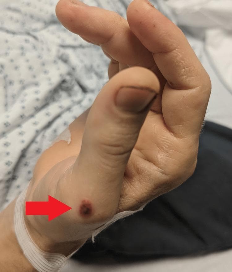 This clinical photograph displays a primary skin lesion on the lateral aspect of a patient's hand near the base of the thumb (thenar eminence). The lesion, highlighted by a red arrow, is a well-demarcated, circular papule approximately 1-2 cm in diameter. Its morphology is characterized by a dark red to violaceous (purpuric) hue with a slightly raised surface and irregular texture. The surrounding skin exhibits a fair tone with faint peripheral erythema. A medical identification band or bandage is visible around the wrist. Clinically, such lesions are associated with systemic conditions, often categorized within vasculitic or rheumatologic frameworks, and may manifest alongside symptoms like arthralgias, fever, and mucosal ulcers. The image serves as an educational tool for identifying discrete purpuric papules in the context of multi-systemic disease.
