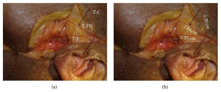 This clinical photograph displays a surgical dissection of the preauricular and parotid regions, illustrating the surgical anatomy and morphometric relationships of the facial nerve. The image is divided into two panels (a and b) showing the same field with anatomical labels and measurements. Key landmarks identified include the tragus (T), the lateral pole of the mandibular condyle (C), the pes anserinus (P) of the facial nerve, and the temporozygomatic division of the facial nerve (FN). Panel (b) specifically quantifies the distances from the posterior apex of the tragus to these landmarks: 2.20 cm to the lateral pole of the condyle (T-C), 2.31 cm to the point where the facial nerve crosses the posterior border of the condylar neck (T-FN), and 2.25 cm to the pes anserinus (T-P). This anatomical diagram serves as a guide for identifying and preserving the facial nerve during preauricular surgical approaches, such as those used in parotidectomy or temporomandibular joint surgery, by providing standardized reference measurements from the tragus.