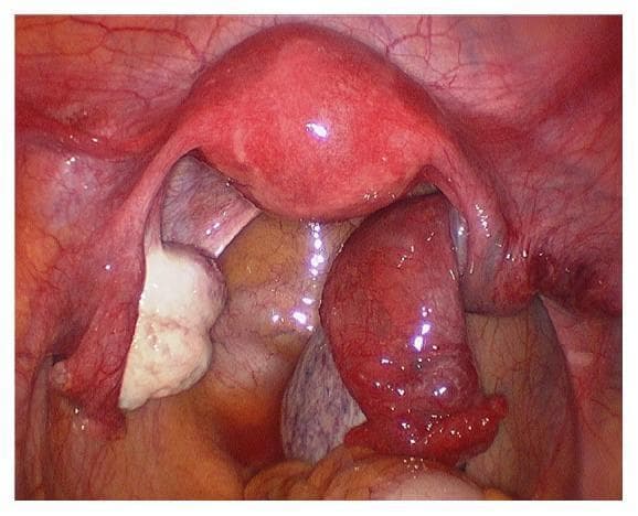 This diagnostic laparoscopic photograph illustrates the female internal pelvic reproductive organs, providing a clear comparison between normal anatomy and adnexal pathology. Centrally located is the uterus, appearing smooth, pear-shaped, and pinkish-red. To the viewer's left, the left ovary is visible as a pale, white, nodular structure with a healthy appearance, accompanied by a normal-looking fallopian tube. In stark contrast, the right adnexa (viewer's right) exhibits signs of acute pathology. The right ovary and fallopian tube are significantly enlarged, edematous, and demonstrate a dusky, deep-red to purple discoloration, consistent with venous congestion and hemorrhagic infarction. The right fallopian tube appears thickened and twisted upon its pedicle. This visual presentation is characteristic of ovarian torsion, a surgical emergency where the twisting of the adnexa compromises blood supply. The image is highly relevant for medical education in gynecology and emergency medicine, demonstrating the clinical signs of ischemic adnexal torsion compared to contralateral healthy structures.