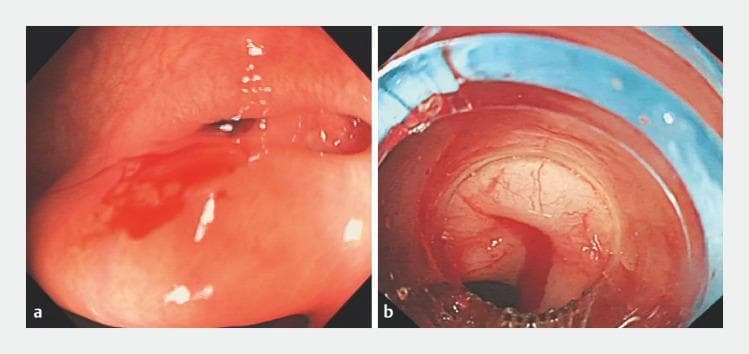Two side-by-side endoscopic images (colonoscopy) demonstrating colonic diverticular bleeding and subsequent intervention. Image (a) shows a focal point of active hemorrhage originating from a diverticulum in the transverse colon. The mucosa appears erythematous and edematous, with a pool of fresh, bright red blood collecting on the dependent wall. Image (b) captures a recurrent bleeding episode at the same site, viewed through an endoscopic ligation cap. A stream of active bleeding is visible within the center of the field. A blue elastic band is visible, positioned for endoscopic band ligation (EBL). The mucosal tissue within the ligation device appears blanched due to mechanical compression. These images illustrate the diagnostic visualization of lower gastrointestinal bleeding and the application of mechanical hemostasis when initial clip placement has failed. This content is intended for intermediate to advanced medical learners studying gastroenterology and emergency endoscopic procedures.