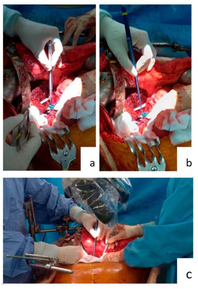 A series of clinical photographs illustrating the use of different surgical forceps during a complex abdominal procedure, specifically hepatic artery anastomosis. Image (a) shows a surgeon using standard 15 cm long metallic silver forceps; the shorter length forces the surgeon's hand deep into the operative field, resulting in a more cramped, pinched grip against the palm. Image (b) demonstrates the use of 25 cm long micro-forceps, characterized by a blue-coated finish and significant longitudinal reach. This instrument allows the surgeon to maintain a more relaxed, upright hand position further from the anatomical structures, providing better leverage and visibility. Image (c) displays a collaborative surgical field where both the primary surgeon and the first assistant are utilizing long micro-forceps simultaneously under a surgical microscope. This configuration highlights the ergonomic advantage of longer instruments in deep surgical sites, such as those obstructed by the ribcage, enabling precise tissue manipulation and suturing without the hands of the surgical team crowding the central operative view.