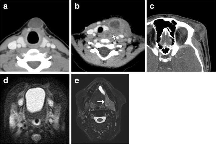 A multi-panel medical image illustrating various tumor-like lesions of the head and neck using CT and MRI modalities. Axial CT image (a) displays a well-circumscribed, homogenous, low-attenuation thyroglossal duct cyst in the midline anterior neck. Image (b) shows an infected left-sided branchial cleft cyst characterized by a thick, irregular wall and surrounding inflammatory fat stranding; an arrow indicates a distended sinus tract extending toward the hypopharynx. Image (c) demonstrates a ruptured periorbital dermoid cyst in the left lateral region, showing internal fat attenuation and significant adjacent soft tissue inflammation. Axial fat-suppressed T2-weighted MRI (d) identifies a hyperintense, well-defined midline foregut duplication cyst in the oral cavity. Image (e) reveals a complex, hyperintense left sublingual lesion (arrow) representing a cystadenocarcinoma associated with a ranula. The collection serves as an educational comparison of congenital, inflammatory, and neoplastic cystic masses, highlighting key radiological features like location, attenuation, signal intensity, and the presence of sinus tracts or inflammation.