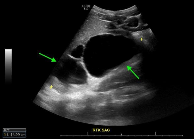 A sagittal view B-mode ultrasound of the left kidney (RTK SAG label in image) demonstrating Grade IV hydronephrosis. The renal pelvis is severely dilated and appears as a large, central anechoic (dark) space. Green arrows point to specific pathological features: the left arrow indicates significant cortical thinning of the renal parenchyma, while the right arrow highlights hyperechoic (bright) debris or proteinaceous material layered within the dependent portion of the dilated renal pelvis. The kidney measures approximately 14.99 cm as indicated by the calipers. These sonographic findings are consistent with chronic obstructive uropathy, such as that caused by posterior urethral valves (PUV). The visible reduction in cortical thickness suggests long-standing pressure and potential chronic kidney disease. This image serves as a diagnostic tool for assessing the severity of urinary tract obstruction and renal parenchymal damage.