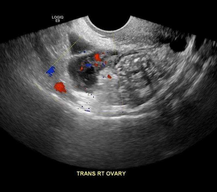 This diagnostic image is a transabdominal ultrasound of the right adnexa in the transverse plane, demonstrating a complex right tubo-ovarian abscess (TOA) measuring approximately 6.2 x 3 x 2.5 cm. The mass exhibits a heterogeneous echotexture with mixed cystic and solid components, characterized by internal low-level echoes and irregular thick walls. The borders of the mass are poorly defined and irregular, blending with adjacent pelvic structures, which is indicative of localized inflammation and pelvic inflammatory disease (PID). Color Doppler overlay reveals internal and peripheral vascularity, showing punctate red and blue signals that represent blood flow within the inflammatory tissue. There is no clear evidence of posterior acoustic shadowing or enhancement. This visual finding is a key diagnostic indicator for advanced pelvic infection and is used in clinical education to distinguish complex adnexal masses from simple ovarian cysts or endometriomas.