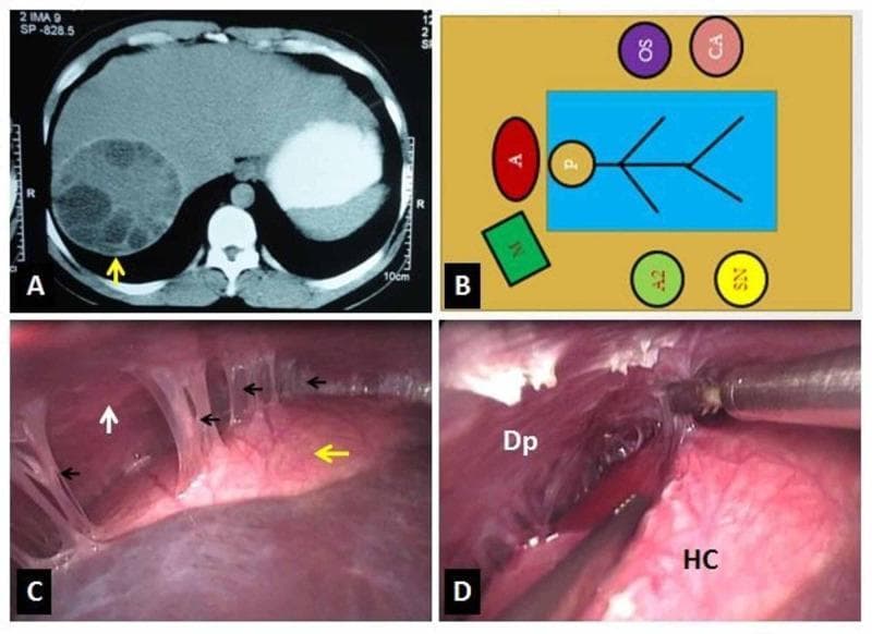 This composite image provides a comprehensive clinical overview of a hepatic hydatid cyst and its surgical management. Panel A is a contrast-enhanced axial CT scan of the abdomen, showing a large, multiloculated cystic lesion in the right lobe of the liver. The lesion contains internal daughter cysts, characteristic of Echinococcus granulosus infection. Panel B is a schematic diagram illustrating the operating theatre layout for a laparoscopic approach, identifying the positions of the patient, surgeons, and equipment. Panel C is an intraoperative laparoscopic photograph demonstrating the hydatid cyst (yellow arrow) positioned against the diaphragm (white arrow), with dense fibrous adhesions (black arrows) connecting the two. Panel D shows the active surgical step of adhesiolysis, where the cyst (HC) is being carefully separated from the diaphragmatic (Dp) surface using laparoscopic instruments. This sequence illustrates the transition from radiological diagnosis to surgical visualization and intervention for complex liver parasite management.