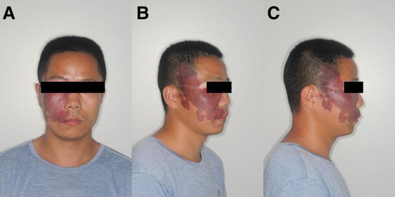This clinical photograph series displays three views (frontal, 45° lateral, and 90° lateral) of a male patient presenting with a prominent facial capillary malformation, commonly referred to as a port-wine stain. The lesion is strictly unilateral, affecting the right side of the face. It involves the distribution of the first (ophthalmic) and second (maxillary) divisions of the trigeminal nerve, extending from the forehead and periorbital region across the cheek and nasal sidewall to the upper cutaneous lip and preauricular area. The lesion exhibits a characteristic dark red to 'grape-colored' erythema with irregular but well-defined borders. Visually, the affected skin shows signs of hypertrophy and textural changes, including areas of thickening and a slightly cobble-stoned or flaky surface. This presentation is a hallmark cutaneous sign often associated with neurocutaneous syndromes such as Sturge-Weber syndrome. The images demonstrate the significant facial asymmetry caused by the vascular malformation and are used for clinical diagnosis and documentation of disease extent.