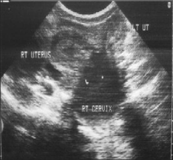 Diagnostic Image: Transabdominal ultrasound of the female pelvis in a transverse plane. The imaging reveals a Müllerian duct anomaly, specifically a didelphys uterus characterized by two distinct, widely divergent uterine horns labeled 'RT UTERUS' and 'LT UT'. There is no visible communication between the two endometrial cavities. Below the right uterine horn, the 'RT CERVIX' is shown to be significantly distended and enlarged, containing low-level internal echoes consistent with hematocervix or fluid accumulation. The anatomy demonstrates a failure of fusion of the paramesonephric ducts. This visual is clinically significant for diagnosing obstructive reproductive tract anomalies and teaching the sonographic presentation of uterine malformations associated with possible cervical stenosis or vaginal septa.