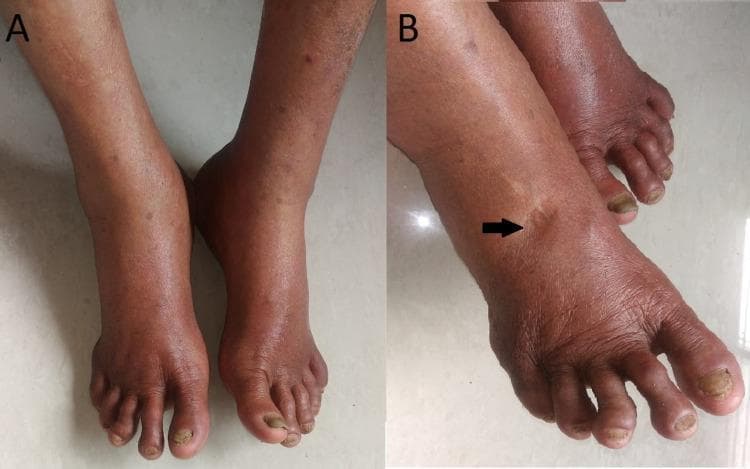 A two-panel clinical photograph illustrating bilateral lower extremity edema. Image A shows a superior view of both feet and ankles, demonstrating significant, symmetrical swelling (pedal edema) that obscures normal bony landmarks. The skin appears taut with subtle reddish-brown hyperpigmentation and scattered macules. Image B provides a lateral-oblique view of the dorsal foot where a black arrow points to a distinct, localized indentation, confirming the 'pitting' phenomenon. The skin in this region is stretched and shiny. Secondary findings include thickening and yellowish discoloration of the toenails, characteristic of onychomycosis. This visual documentation is used in medical education to teach the clinical physical examination of fluid retention and peripheral edema associated with systemic or inflammatory conditions such as post-viral sequelae (e.g., Chikungunya).