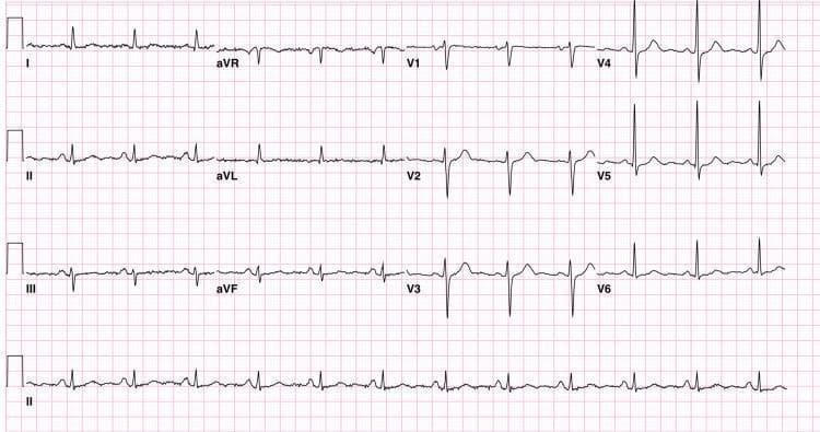 A standard 12-lead diagnostic electrocardiogram (ECG) recorded on pink grid paper. The tracing displays leads I, II, III, aVR, aVL, aVF, and precordial leads V1-V6, with a continuous rhythm strip of lead II at the bottom. The image illustrates a normal sinus rhythm with a stable baseline and regular R-R intervals. Key waveform characteristics include visible P waves preceding each QRS complex, narrow QRS complexes of normal duration, and concordant T waves. In the precordial leads (V1-V6), there is normal R-wave progression. No significant ST-segment deviations, pathological Q waves, or acute ischemic changes are observed. Calibration markers at the beginning of each row indicate standard voltage (10mm/mV). This clinical image serves as a reference for normal cardiac electrical activity in an adult patient, useful for teaching basic ECG interpretation and distinguishing healthy conduction from pathology.