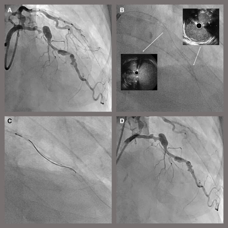 A composite of diagnostic images illustrating a percutaneous coronary intervention (PCI) procedure for coronary artery disease. Panel A is an initial coronary angiogram showing significant focal stenosis and irregular luminal diameter in a major coronary artery branch. Panel B displays an intra-procedural fluoroscopic image with two circular intravascular ultrasound (IVUS) insets; the IVUS cross-sections reveal a guidewire positioned outside the existing stent strut boundaries (extrastent tracking). Panel C demonstrates the corrective rewiring process using a double-lumen microcatheter to re-enter the true lumen. Panel D provides the final coronary angiogram following drug-coated balloon dilatation, showing a restored arterial lumen with smooth contours and resolved stenosis. This sequence serves as an educational tool for identifying stent-related complications, utilizing IVUS for diagnostic precision, and documenting successful coronary revascularization outcomes.