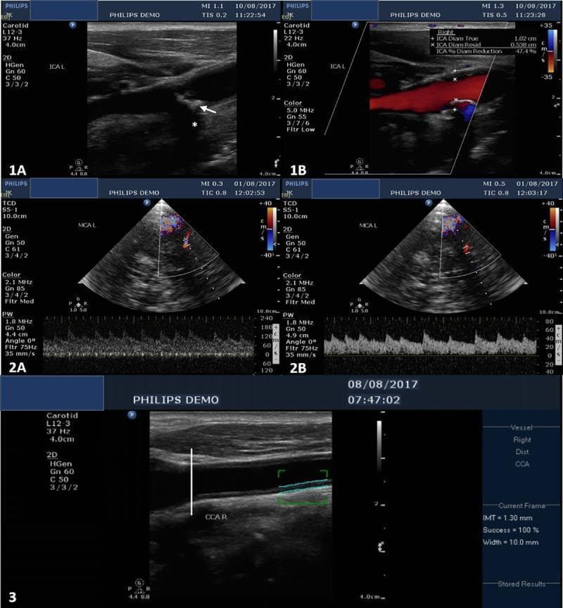 A composite diagnostic image set demonstrating extracranial and intracranial ultrasound imaging for atherosclerosis assessment. Panels 1A and 1B show B-mode and color Doppler longitudinal sections of the left carotid bulb, respectively. 1A identifies an isoechoic regular plaque (white arrow) with focal calcification causing characteristic acoustic shadowing (white asterisk). 1B illustrates a 47% diameter reduction due to this plaque. Panels 2A and 2B display Transcranial Color-Coded Duplex (TCCD) and Pulse Wave Doppler spectra of the left middle cerebral artery (MCA). 2A shows a stenotic segment with increased Peak Systolic Velocity (PSV) of 187 cm/s and Mean Flow Velocity (MFV) of 130 cm/s, while 2B shows a prestenotic segment with lower velocities, yielding a stenotic/prestenotic ratio of 3.25, consistent with >70% stenosis. Panel 3 demonstrates the measurement of carotid intima-media thickness (IMT) in the common carotid artery (CCA) using B-mode ultrasound. The measurement (1.30 mm) is taken in a longitudinal plane 10-30 mm proximal to the carotid bifurcation, indicated by electronic calipers (blue lines). These images serve as educational examples for vascular neurology and radiology.